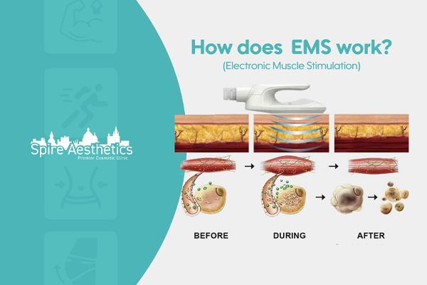 EMS treatment for post pregnancy weight loss treatment Wisley
