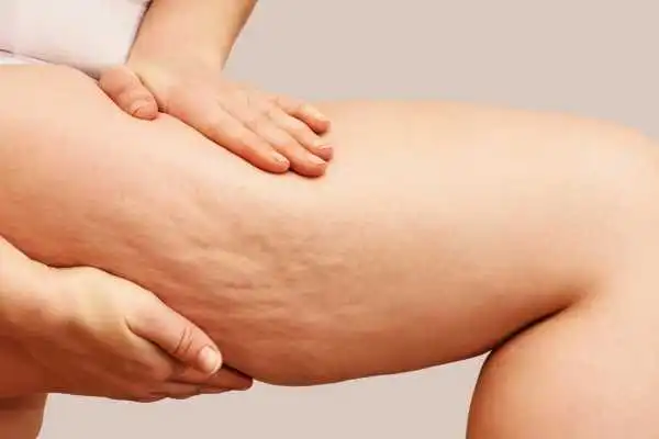 Image of woman showing leg with cellulite Wisley