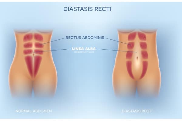 What Non-Surgical Options Are Available for Diastasis Recti Wisley?
