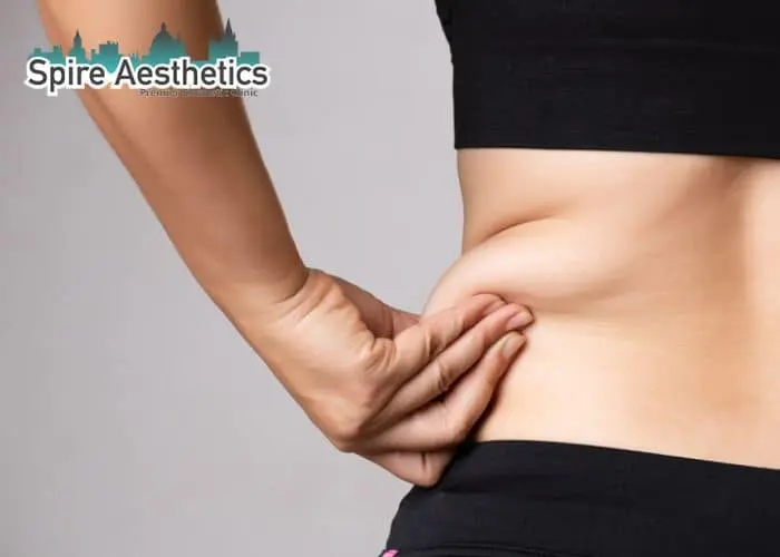 Image of woman pinching fat on their hips Wisley. Fat Freezing treatment