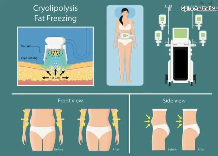 Fat freezing treatment Wisley benefits for competitions to remove stubborn fat deposits.