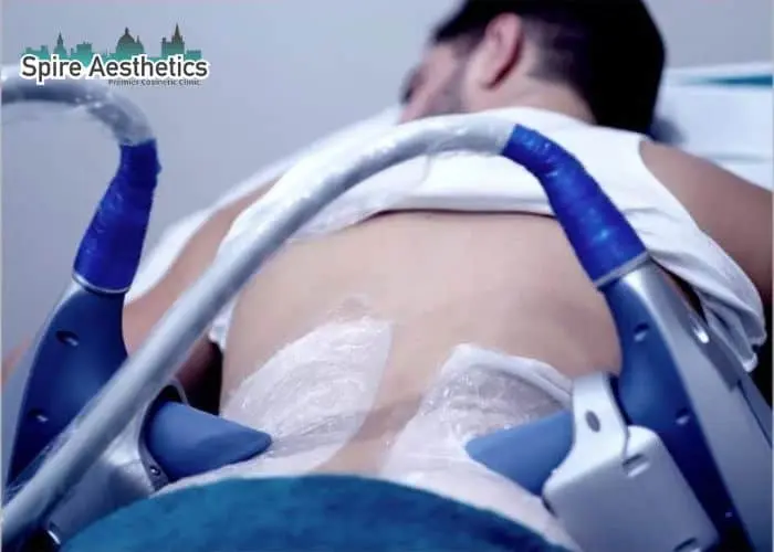Man having fat freezing treatment done on love handles before a competitions Wisley to create a sculpted look.
