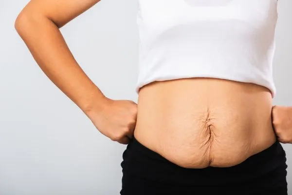 Image of a woman's stomach after weight loss with sagging skin following a gastric band Wisley