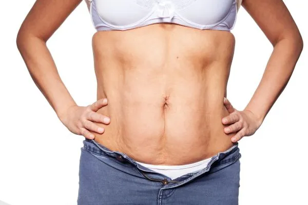 sagging skin on woman's stomach after weight loss injections Wisley