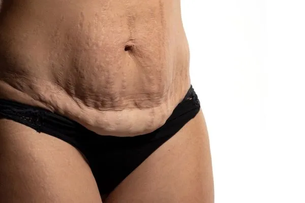 Image of womans stomach after weight loss injections Wisley showing saggy skin
