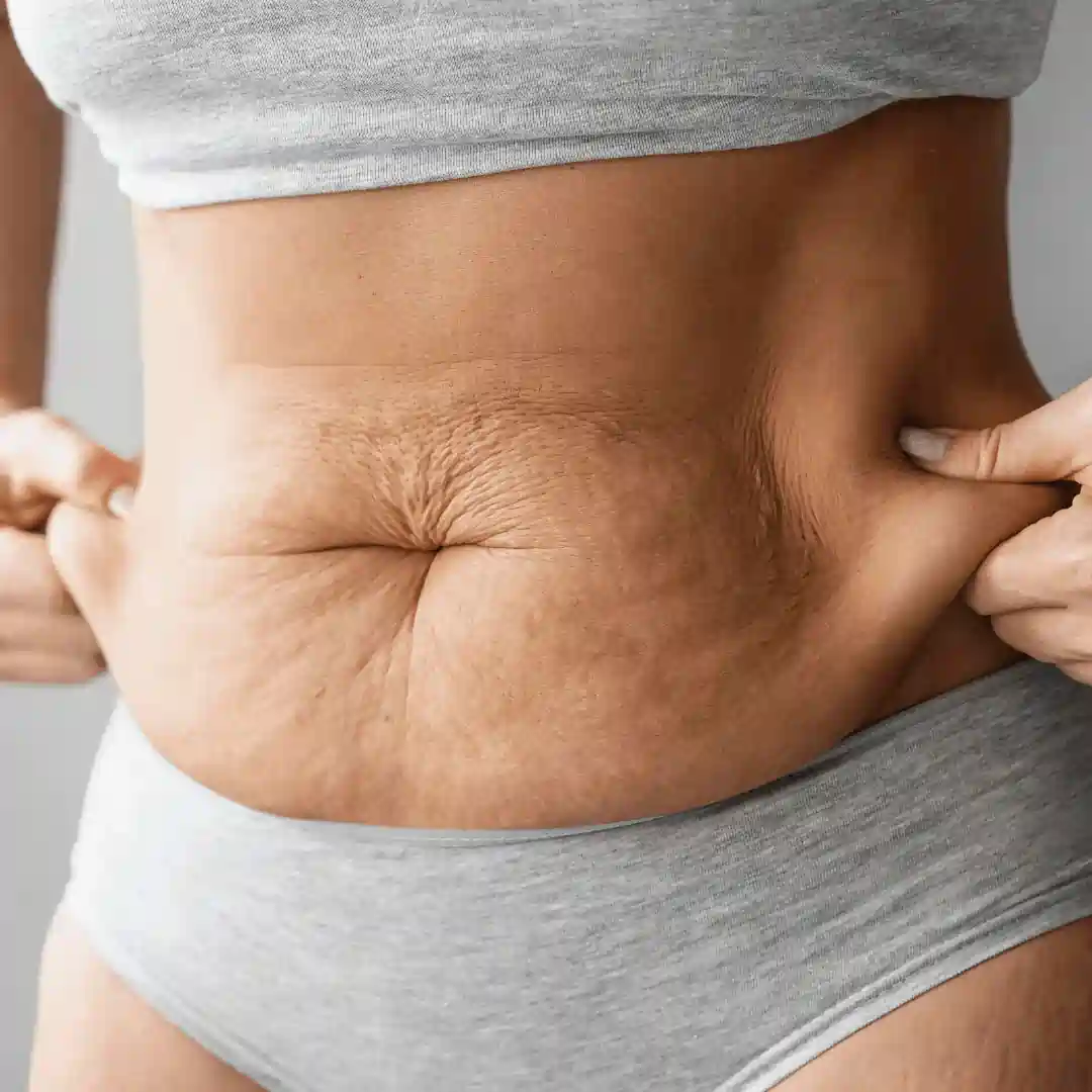 Is It Normal to Have Loose Skin After Pregnancy Wisley?