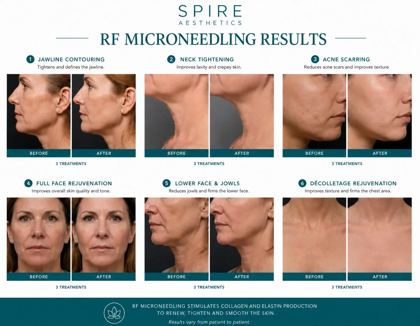 RF Microneedling Skin tightening Wisley results
