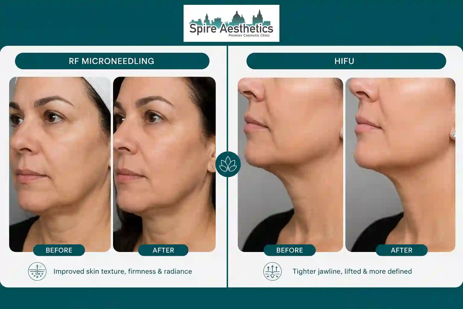 Can RF Microneedling and HIFU Be Combined Wisley?