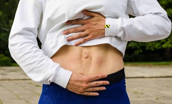 When Could Diastasis Recti Be the Missing Piece of the Puzzle Wisley?