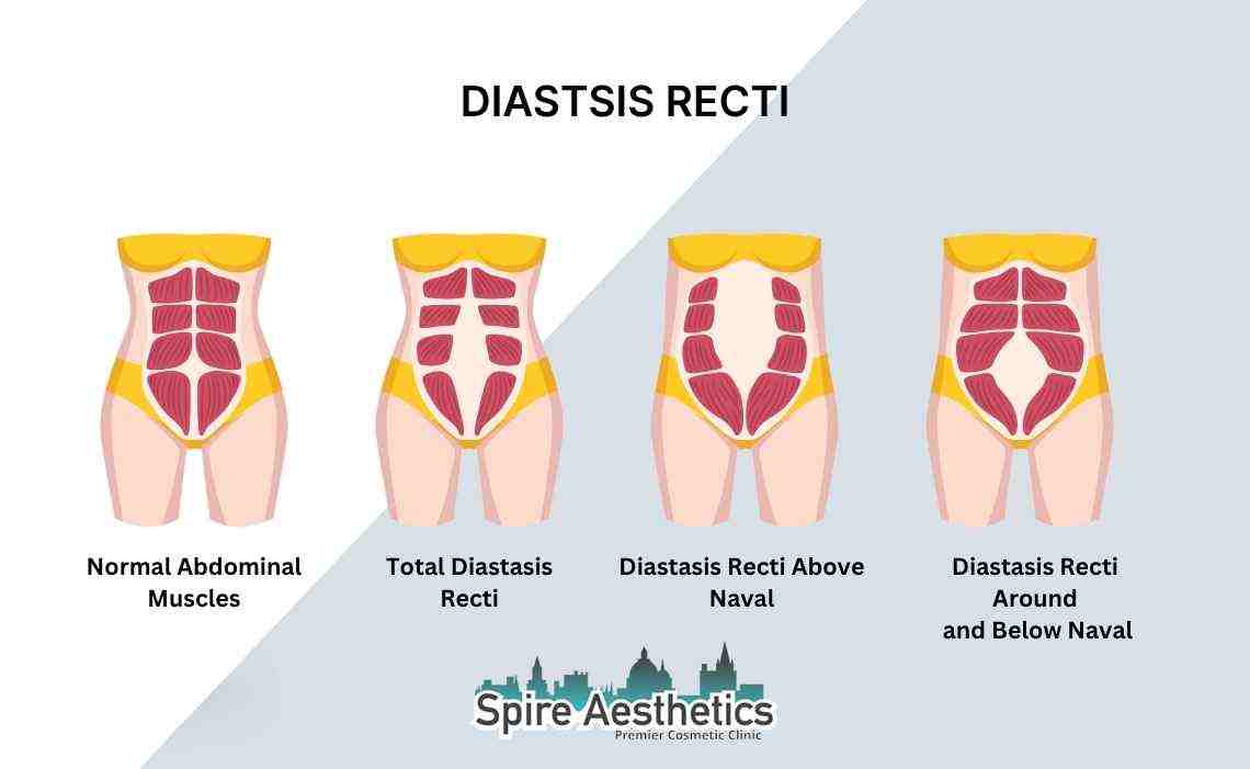 Is Non-Surgical Diastasis Recti Treatment Right for You? Common Concerns Answered Wisley